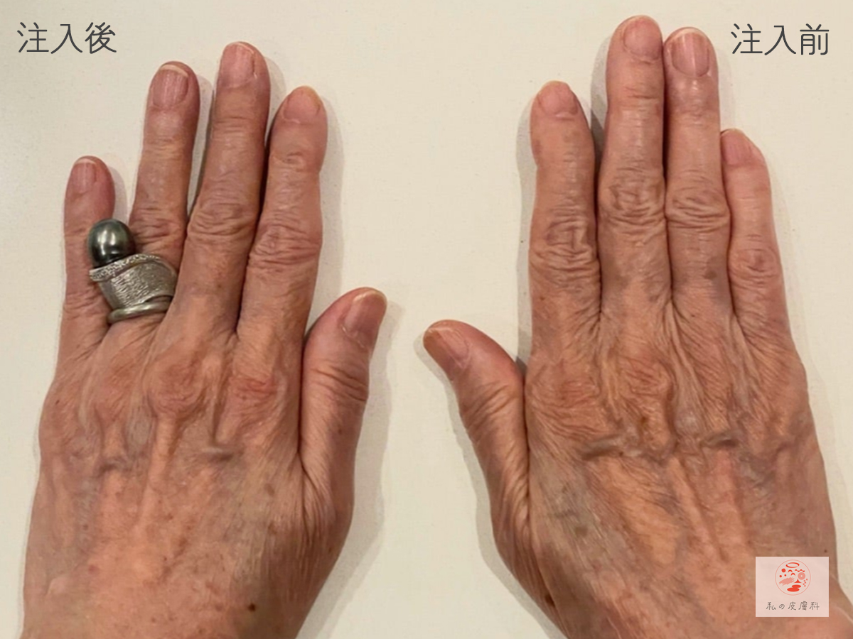 70代女性　施術後