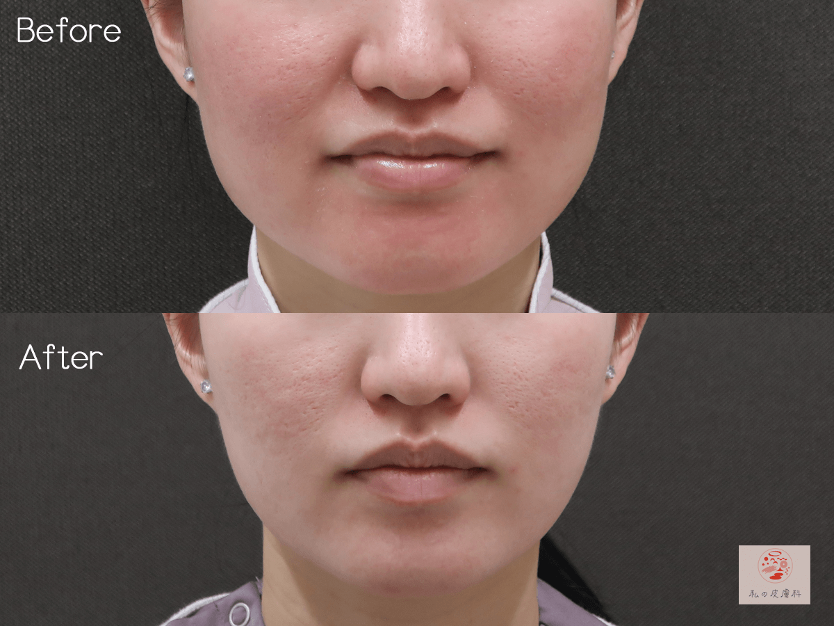 30代女性　エラボトックスによる小顔治療